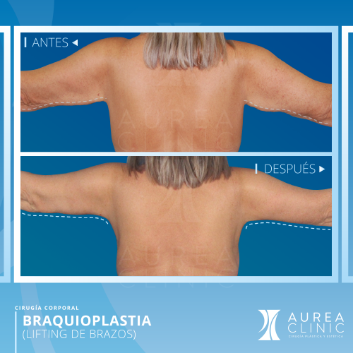 Braquioplastia